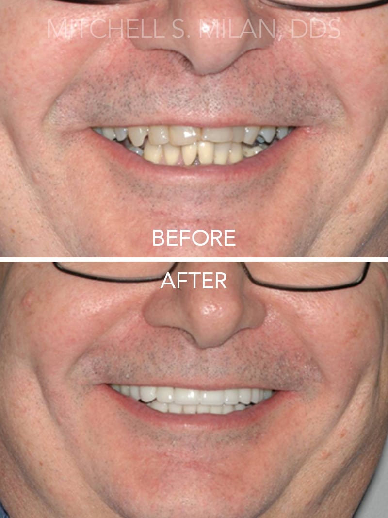 Worn Misshaped Stained Teeth Corrected with Porcelain Veneers and Dental Crowns