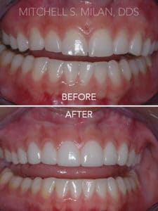 Worn Thin Chipped Teeth Corrected with Porcelain Veneers