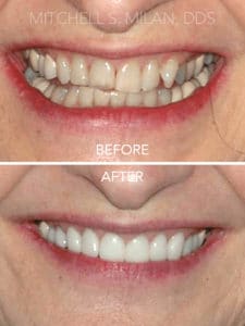 Worn Thin Crooked Teeth Replaced with Porcelain Veneers