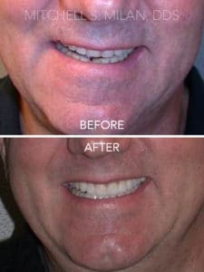 Years of Excessive Tooth Wear Corrected with Porcelain Veneers