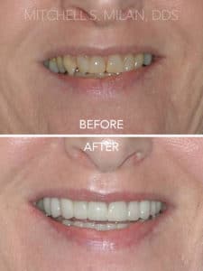 Yellow Crooked Teeth Transformed with Porcelain Veneers