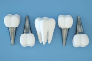 3D Model of Dental Implants on Blue Background
