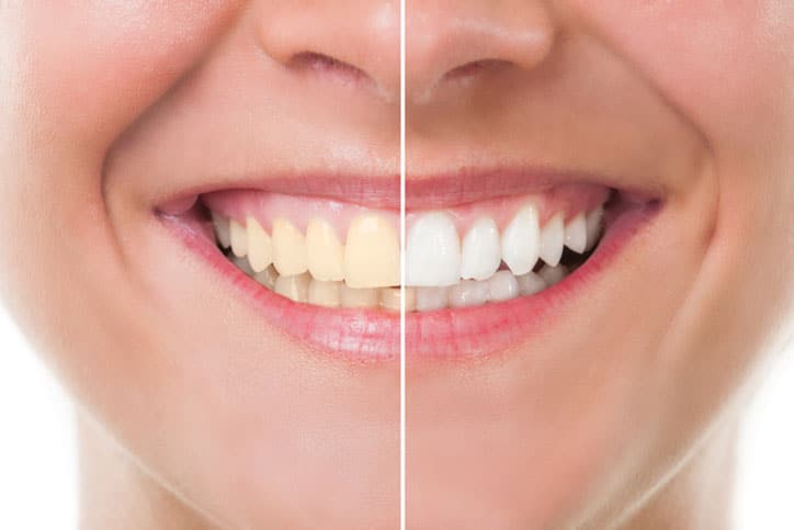 Yellow Teeth Before and After