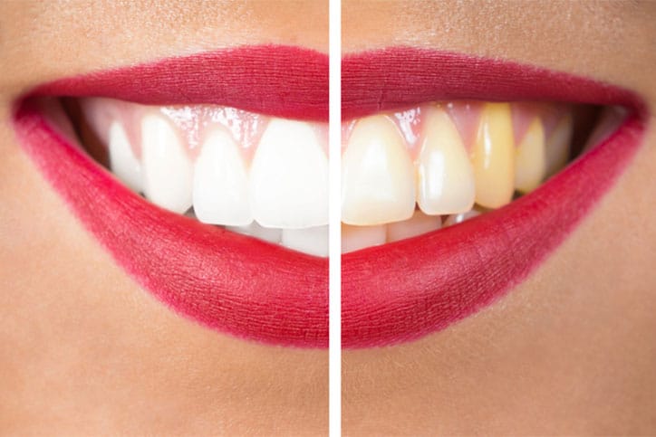 Before and after closeup of yellow teeth.