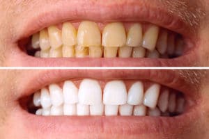 Before and After Smile from Yellow to White Teeth