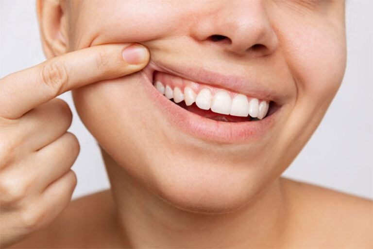 Gum Grafting, All You Need to Know