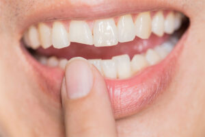 Closeup of Chipped Tooth