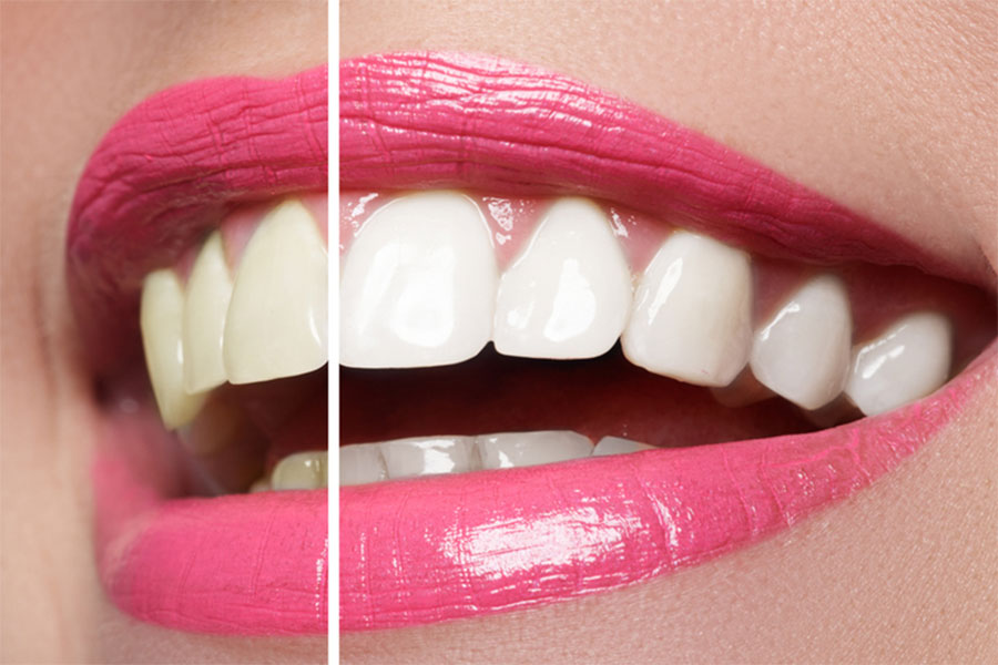 Before and After Teeth Whitening Smile