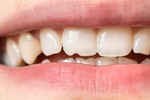Chipped Tooth