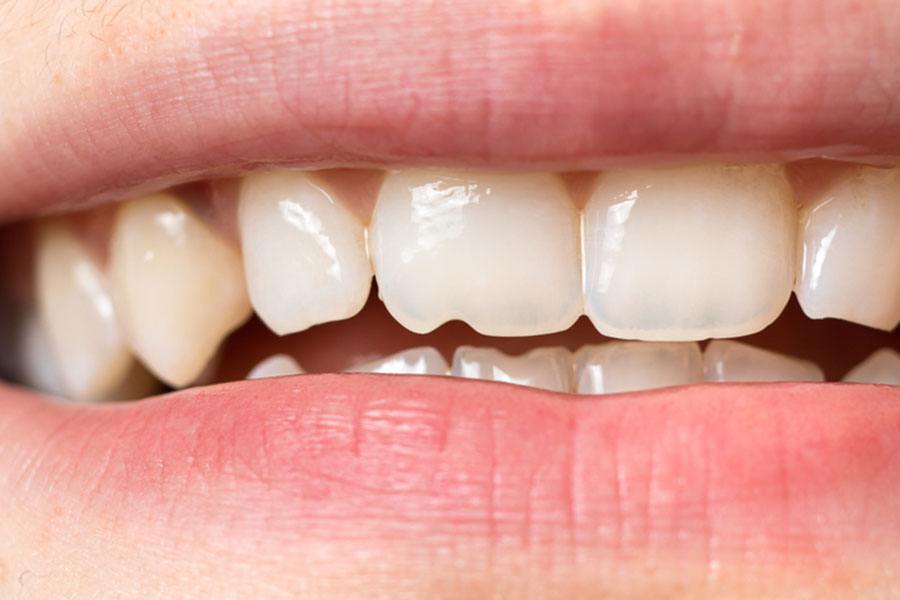 Chipped Tooth