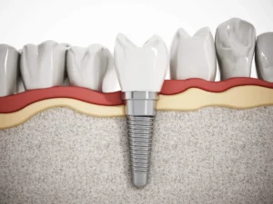 Illustration showing Birmingham dentures and implants.