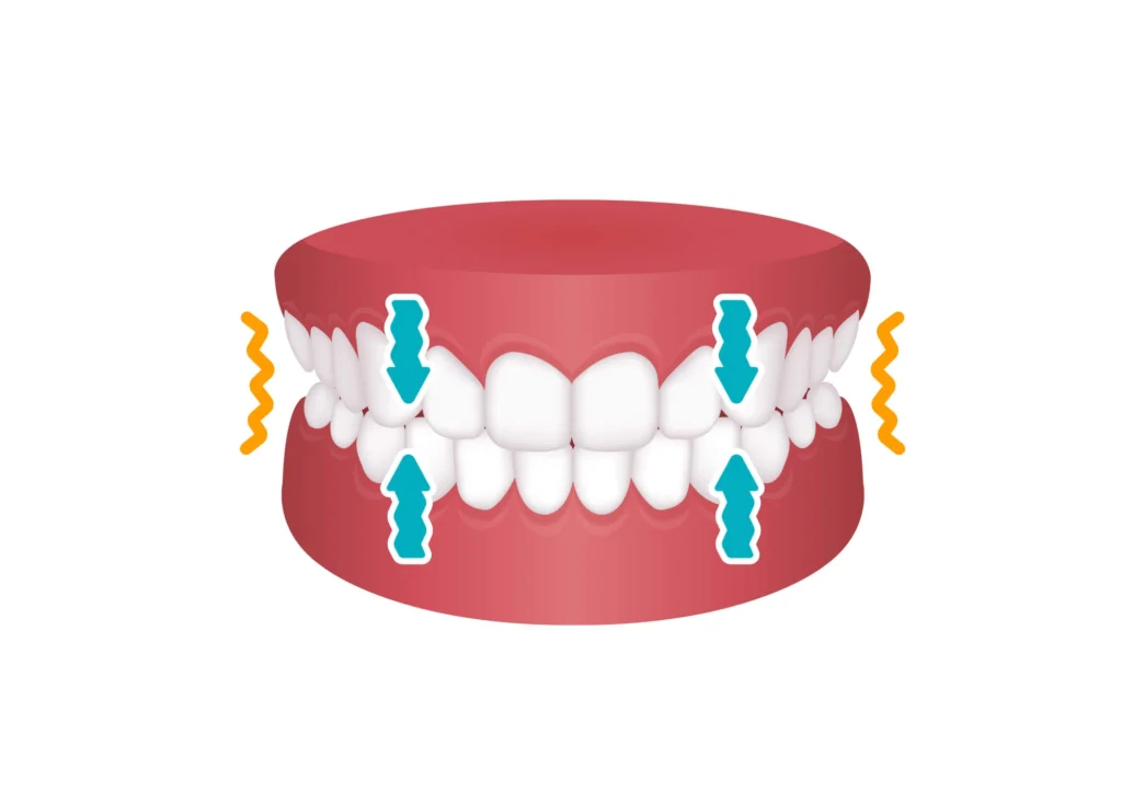 Bruxism vector illustration clenching teeth created by a Dentist in Birmingham MI