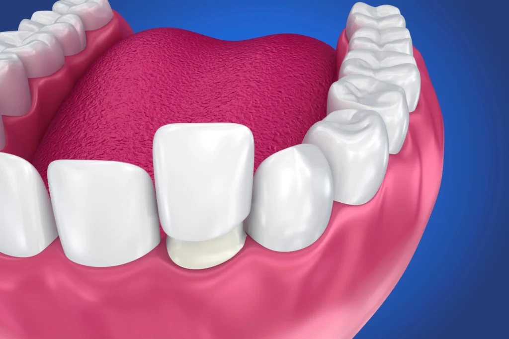 Porcelain Veneer installation Procedure