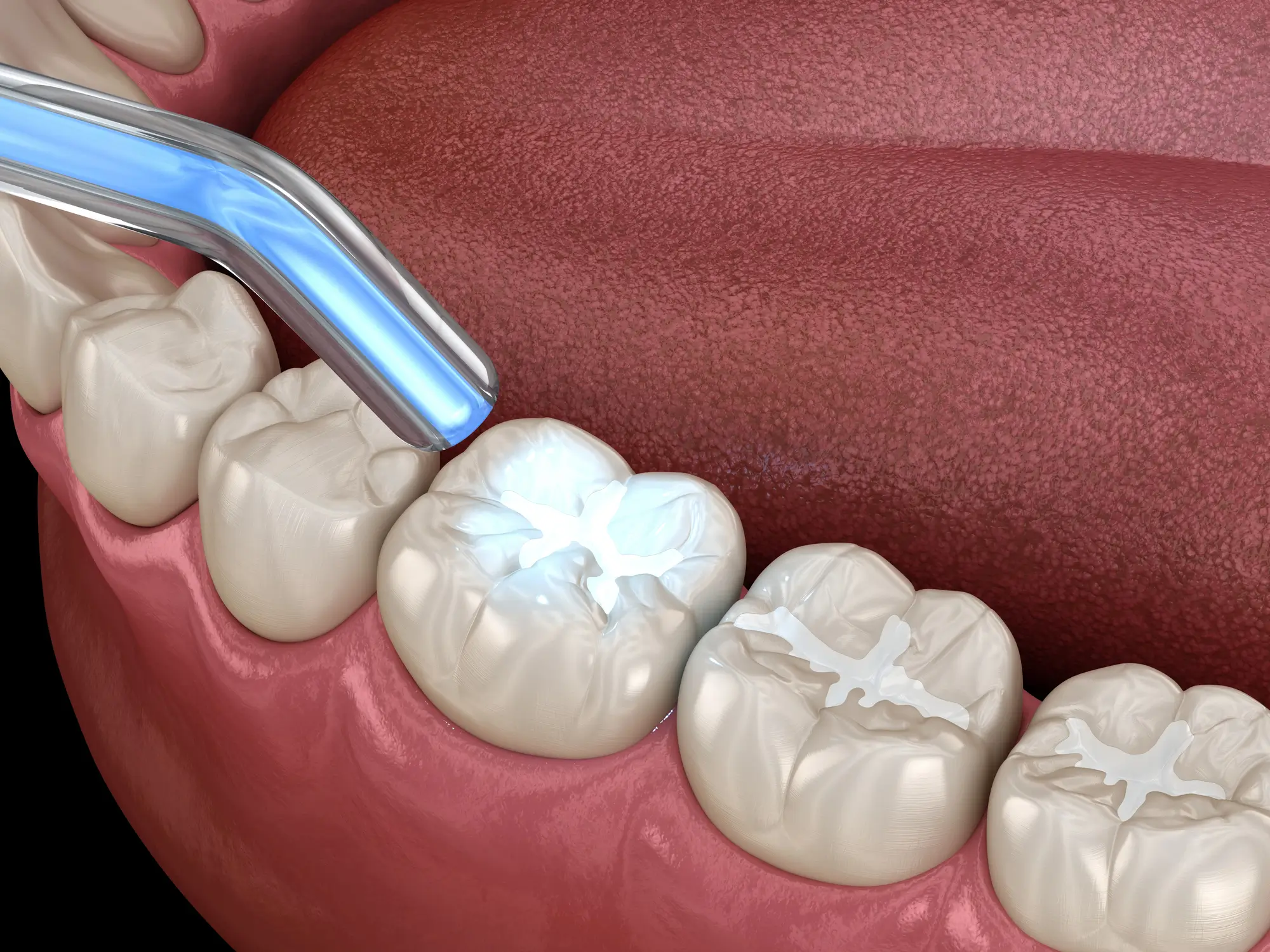Tooth restoration with filling in Restorative Dentistry Birmingham MI treatment.